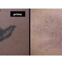 Tatuaggio – Asportazione con laser q-switched