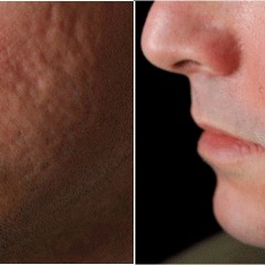 Cicatrici da acne trattate con laser CO2 frazionato