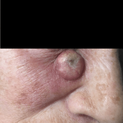 Carcinoma spinocellulare invasivo del volto