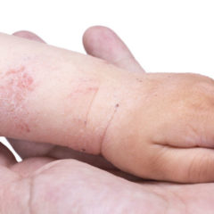Dermatite atopica nei bambini